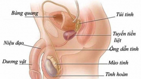 Thắt ống dẫn tinh có làm nam giới yếu sinh lý không ?