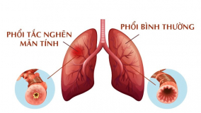 Chung sống hòa bình với bệnh phổi tắc nghẽn mạn tính