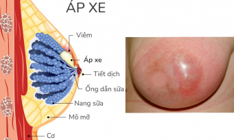 Hậu quả nghiêm trọng khi không xử lý tắc tia sữa kịp thời