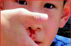 Trẻ chảy máu cam: Hầu hết bố mẹ xử trí sai có thể khiến con gặp nguy hiểm