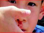 Trẻ chảy máu cam: Hầu hết bố mẹ xử trí sai có thể khiến con gặp nguy hiểm