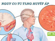 12 triệu người Việt mắc căn bệnh gây ra tai biến mạch máu não: Bộ Y tế đề nghị giảm ăn muối