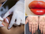 Sau 3 ngày xăm môi, người phụ nữ bị mụn rộp herpes mọc đầy người: Cảnh báo 3 biến chứng chị em nhớ kỹ