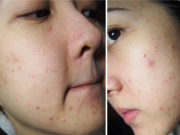 Những loại thực phẩm càng ăn mặt càng nổi mụn, sẹo mụn càng thâm