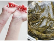 6 loại nước lá tắm có thể cứu bạn khỏi cơn dị ứng, nổi mề đay, giúp mát gan