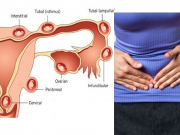 Chửa ngoài dạ con, dấu hiệu nhận biết nguy hiểm