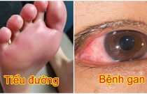 6 vị trí cơ thể hay ngứa ngáy là cảnh báo nội tạng ‘tích’ đầy độc tố, bệnh tật tiềm ẩn bên trong