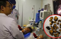 Người phụ nữ bị sỏi to như trứng ngỗng vì ăn hồng: 6 loại quả 'phản bội', hại ruột đừng ăn lúc bụng rỗng