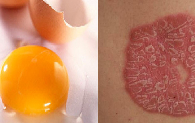 Mẹo cực hay: Chữa bệnh vẩy nến bằng lòng đỏ trứng gà