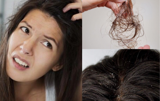 Rụng tóc nhiều ở phụ nữ sau sinh cần làm như thế nào để khắc phục?