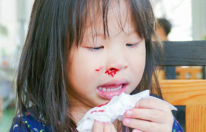 Trẻ bị chảy máu cam: Không ngả đầu ra sau, bằng không sẽ nguy hiểm