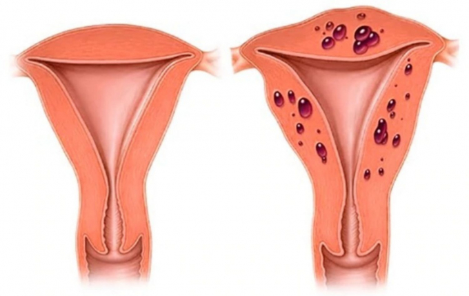Bệnh cơ tuyến tử cung: nguyên nhân và cách điều trị
