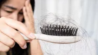 Rụng tóc hiếm gặp có thể chữa được với liều kháng sinh thấp