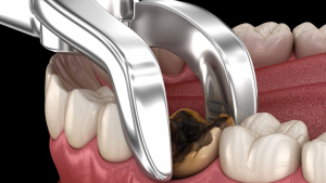 Nhổ răng sâu: Từ khám đến hồi phục