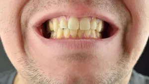 Tại sao đánh răng thường xuyên mà răng vẫn vàng?