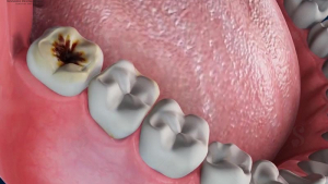 Cách giảm đau răng khôn bị sâu