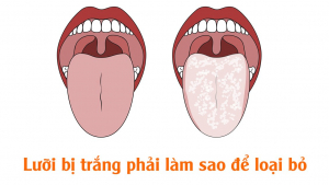 Trào ngược dạ dày có ảnh hưởng đến lưỡi không?