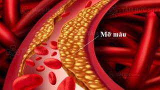 Những dấu hiệu cảnh báo sớm mỡ máu cao tuyệt đối đừng coi nhẹ
