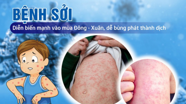 Thủ tướng yêu cầu tăng cường công tác phòng, chống bệnh sởi