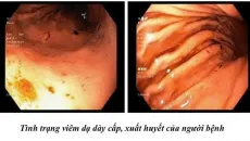 Người bệnh tự ý dùng thuốc gây loét hành tá tràng, nhập viện cấp cứu