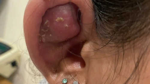 Thiếu nữ tai biến thành 'Trư Bát Giới' sau làm đẹp