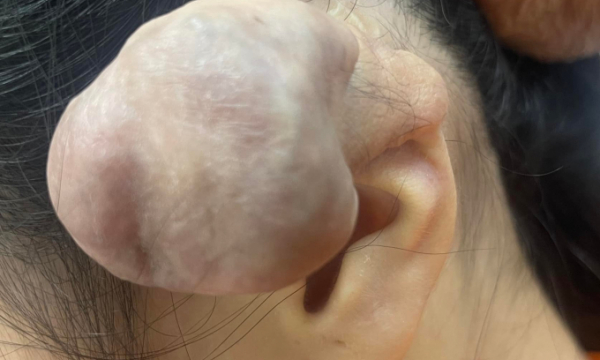 Bấm 6 lỗ xỏ khuyên thể hiện cá tính, cô gái 25 tuổi bị biến dạng tai, nổi khối u lớn phải phẫu thuật