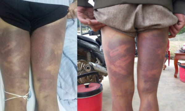 Nghệ An: Một trung úy công an bị cảnh cáo vì đánh dân bầm máu
