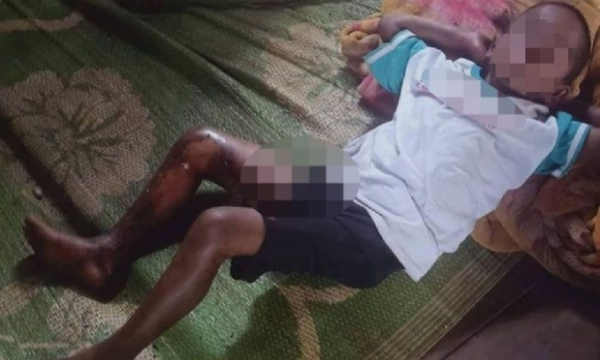 Đắk Lắk: Xác minh vụ bé trai 8 tuổi bị nam thanh niên tẩm xăng đốt