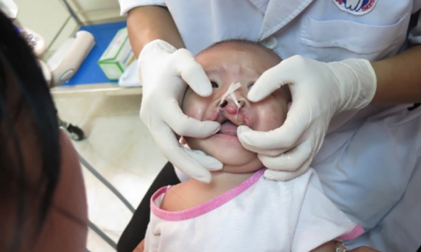 Hơn 20.000 bé bị dị tật khe hở môi – vòm miệng được điều trị toàn diện