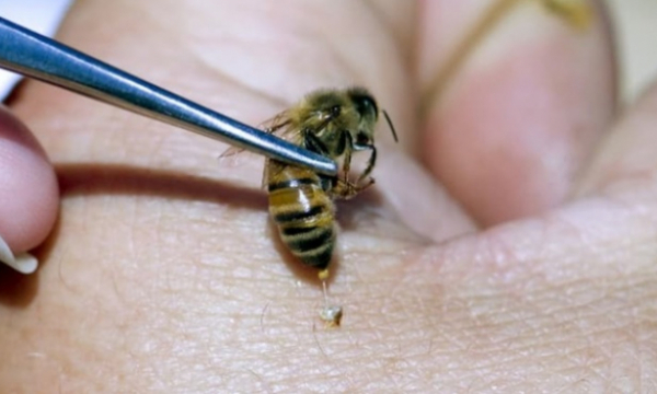 Thực hư thông tin nọc ong chữa ung thư