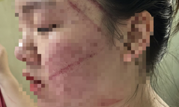 Vụ thiếu nữ 17 tuổi bị mẹ ruột trói, đánh: Điều tra thêm hành vi bạo hành, ngược đãi con cái