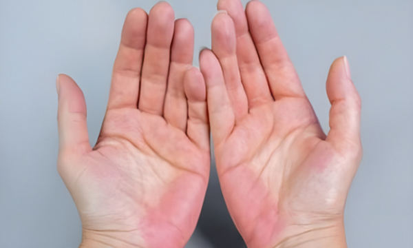 'Bàn tay bệnh gan' có dấu hiệu gì?
