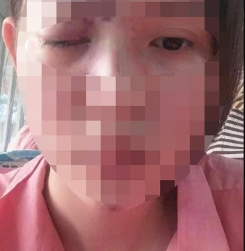 Một nạn nhân nhập viện cấp cứu, mù mắt sau khi tiêm filler tại một spa ở H.Tân Phú