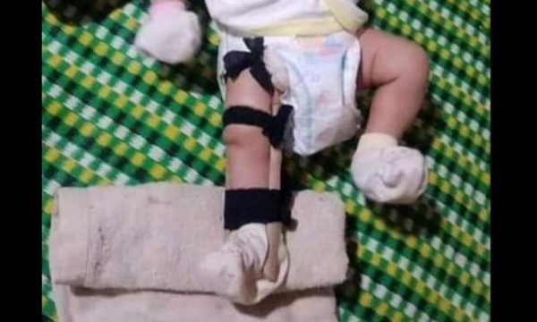Điều tra thông tin bé 2 tháng tuổi bị cha đẻ đánh gãy chân ở Bình Phước