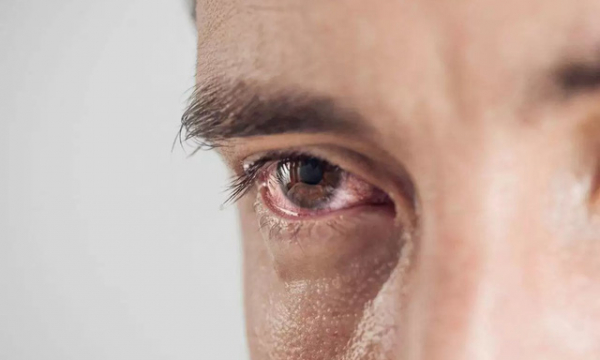Đau mắt cũng có thể là dấu hiệu của COVID-19