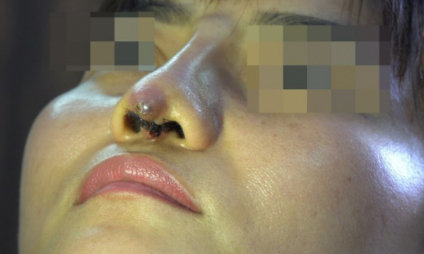 Lâm Đồng: Trụ mũi đứt lìa do 'bác sĩ thẩm mỹ' rởm