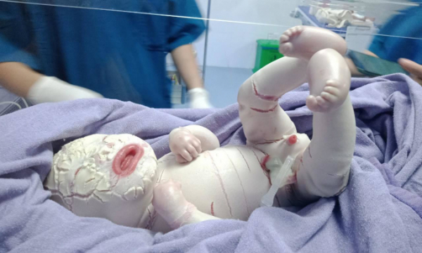 Trẻ sơ sinh ở Quảng Ninh mắc bệnh hiếm gặp, toàn thân bao phủ da dày bị rạn nứt thành từng mảng