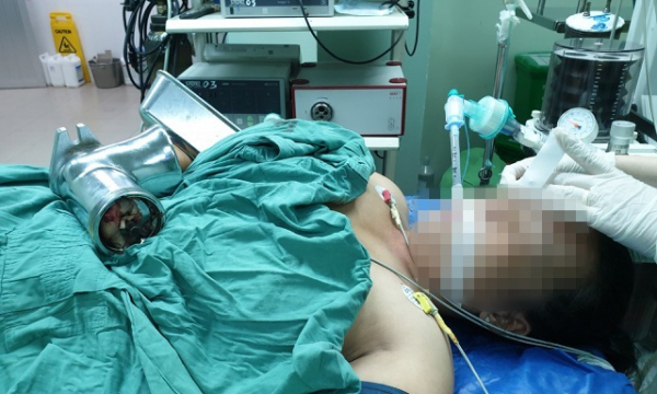 TP Cần Thơ: Người phụ nữ bị dập nát bàn tay vì máy xay cá cuốn vào