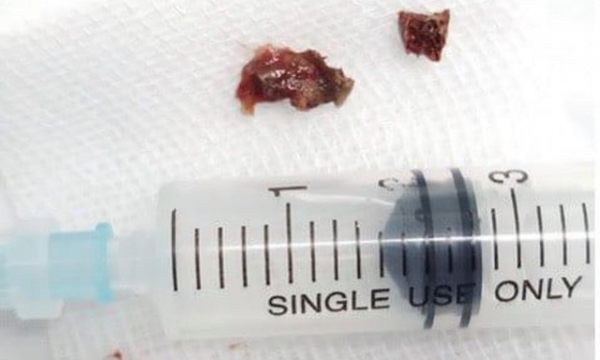 Nữ bệnh nhân 'ho muốn nổ phổi' vì mảnh xương gà bỏ quên