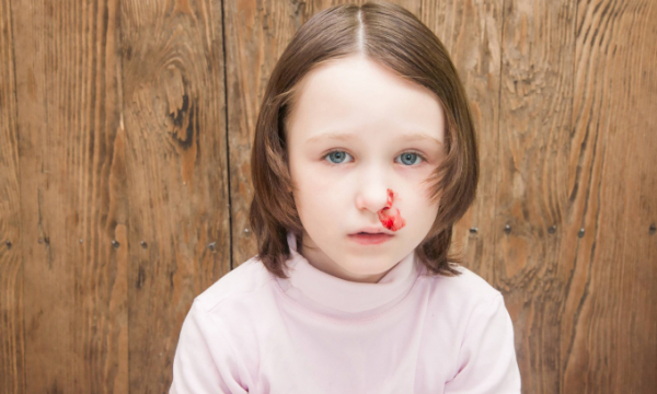 Mẹo ngừa chảy máu cam mùa lạnh cho trẻ