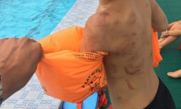 Thầy giáo dạy bơi phát hiện trên người học trò lớp 3 dày đặc vết thương