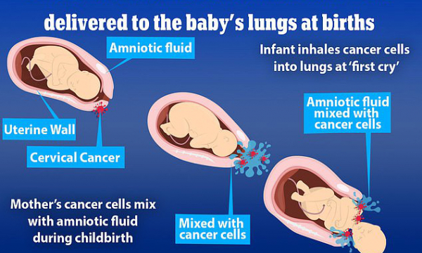Sốc: 2 trẻ sơ sinh Nhật Bản hít phải tế bào ung thư từ mẹ