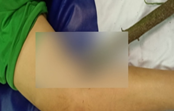 Phẫu thuật thành công bé trai 11 tuổi bị cành cây đâm xuyên đùi
