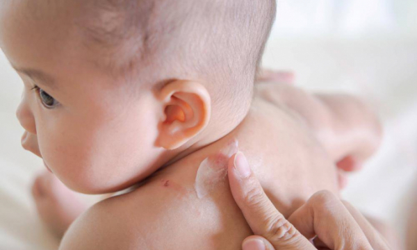Ngăn ngừa, giảm nhẹ nhiễm trùng eczema ở trẻ