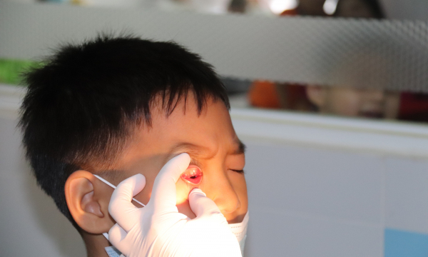 Vì sao không nên nhỏ sữa, xông lá trầu khi điều trị đau mắt đỏ