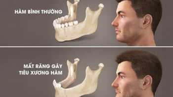 Tiêu xương hàm – Hệ lụy âm thầm từ mất răng và viêm nha chu