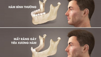 Tiêu xương hàm – Hệ lụy âm thầm từ mất răng và viêm nha chu