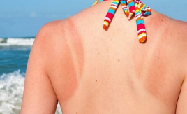 7 bệnh về da thường gặp trong mùa hè và cách phòng tránh