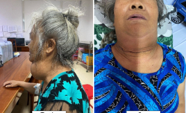 Đắk Lắk: Phẫu thuật thành công cho bệnh nhân bị bướu tuyến giáp khổng lồ