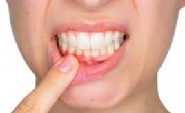 Cách giúp cải thiện tình trạng chảy máu chân răng